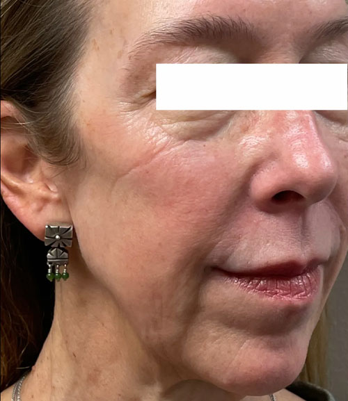 pdo thread lift before